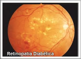 Retinopatia Diabética