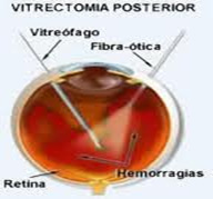 Retinopatia Diabética